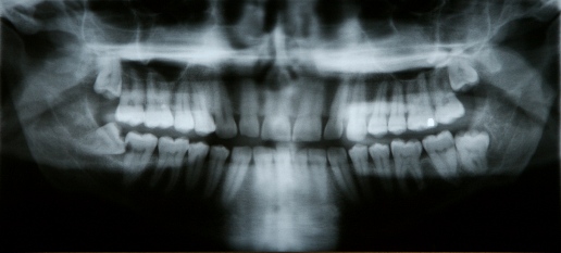 x-ray of patient with impacted tooth