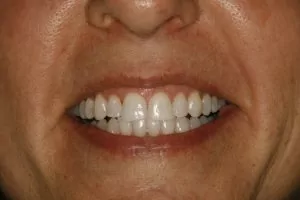 Ginger's smile after cosmetic dental surgery at Ponderosa Dental Group