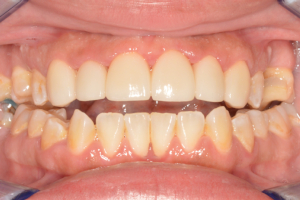 Ponderosa Dental Group cosmetic dentistry patient, after procedure