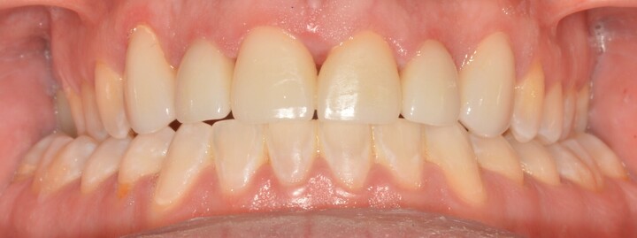 Ponderosa Dental Group cosmetic dentistry patient, after procedure