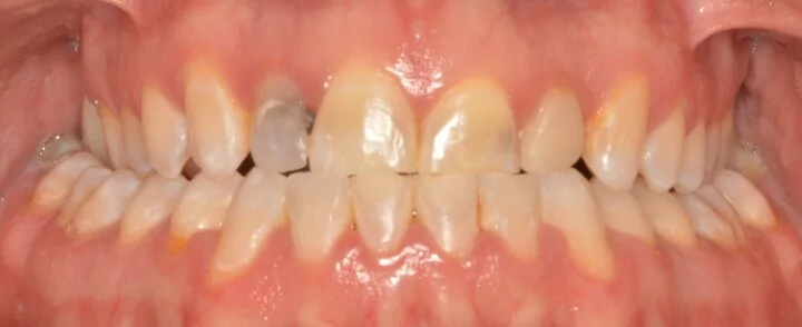 Ponderosa Dental Group cosmetic dentistry patient, before procedure